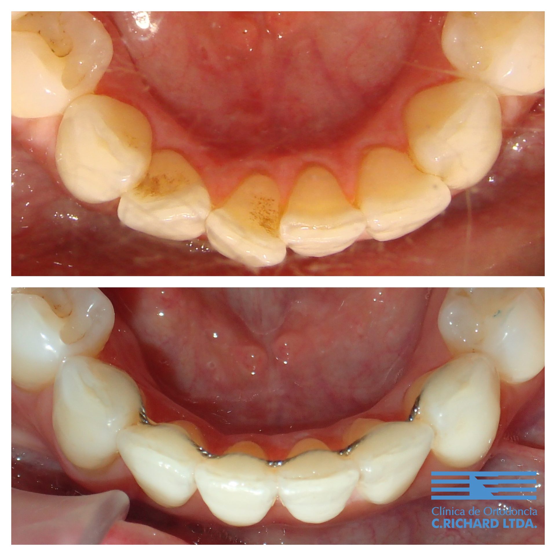 Apiñamiento dentario